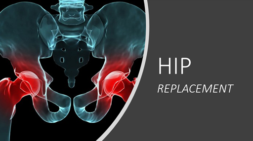 Achievements in hip joint replacement